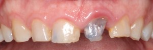 Crown Lengthening