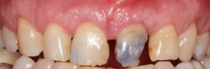 Crown Lengthening