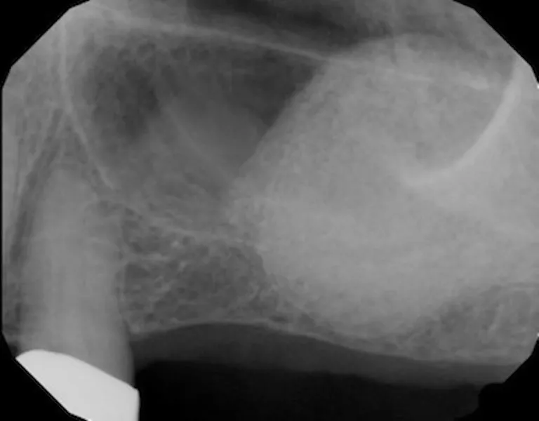 Sinus Augmentation