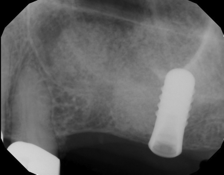 Sinus Augmentation