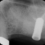 Sinus Augmentation	