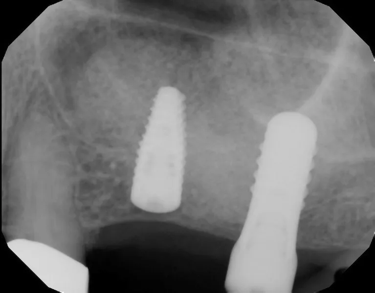 Sinus Augmentation
